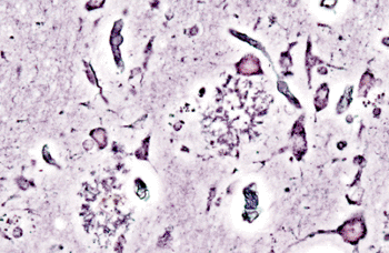 Imagen: Placas en la corteza cerebral muestran la enfermedad de Alzheimer (Fotografía cortesía de Wikimedia Commons).